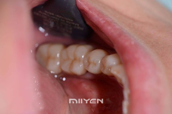 Bloco de zircônia dental multicamadas UT