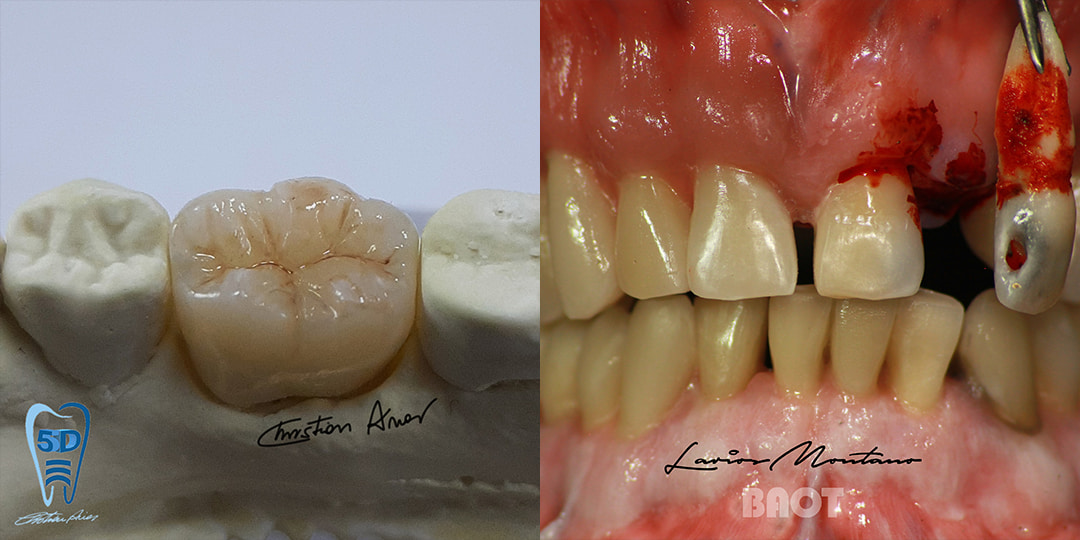 Ponte de porcelana dental dentina transparente