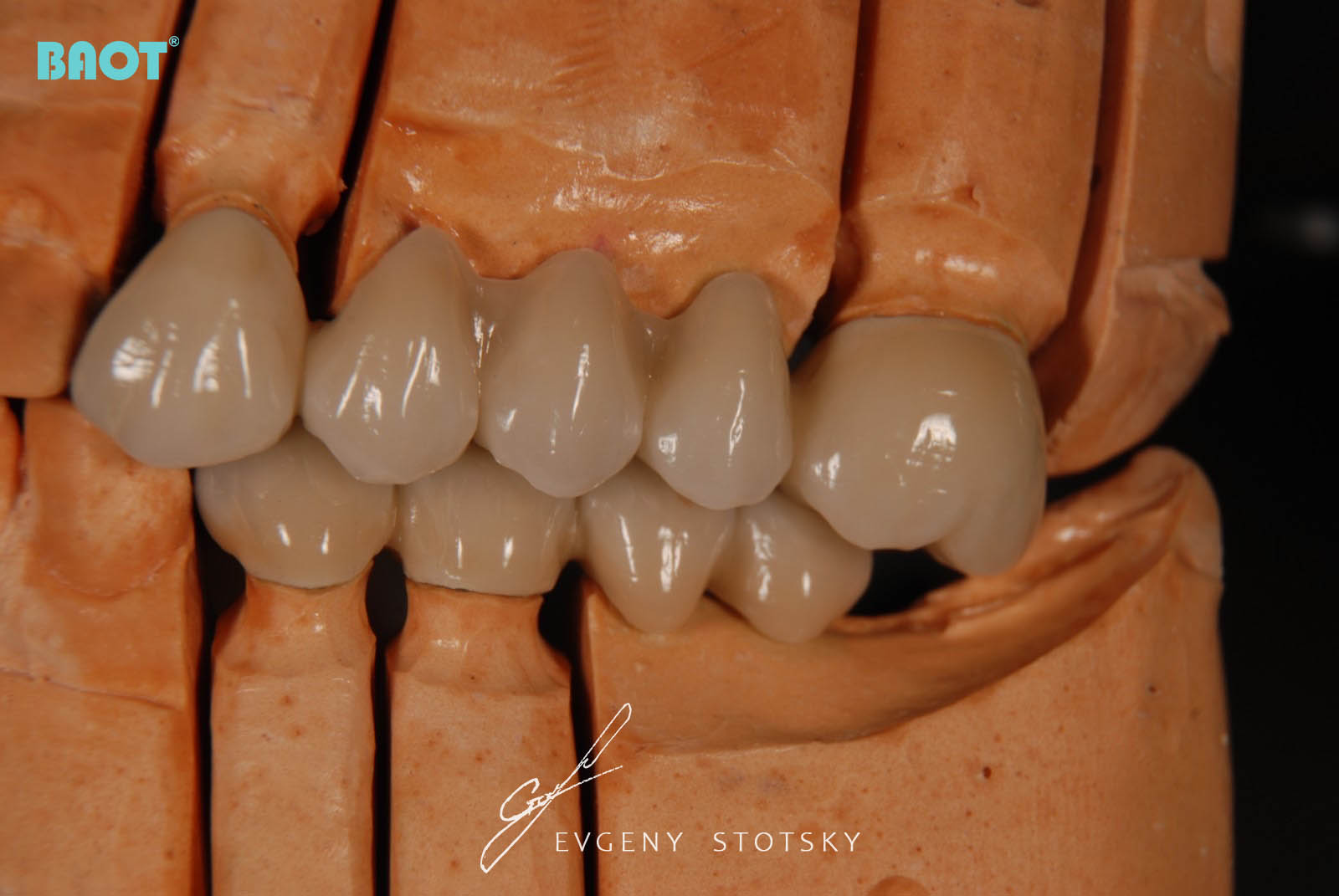 Uso de Cerâmica para Prótese Dentária